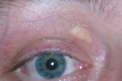 Xanthelasma_palpebrarum-1039018401.jpg