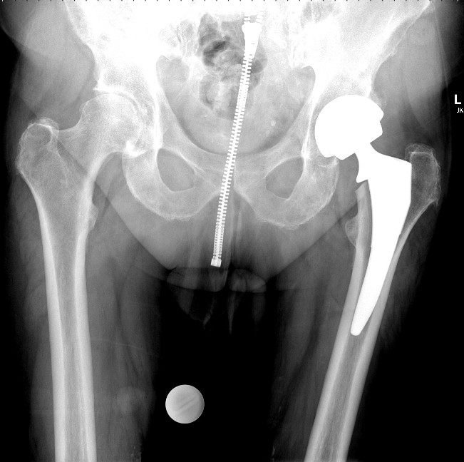 Hip post op.jpg